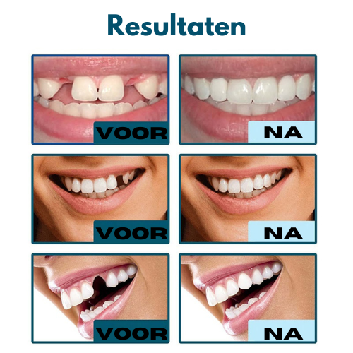 BrightSmile™ - klikbare Tandfacings