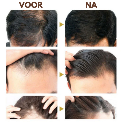 HairPurc™ - Natuurlijke haairgroei olie